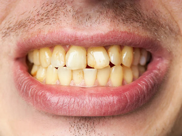 Dientes amarillentos